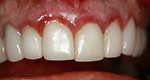 gum-after-veneers