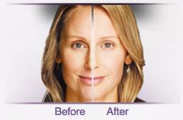 juvederm-2