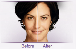 juvederm-3