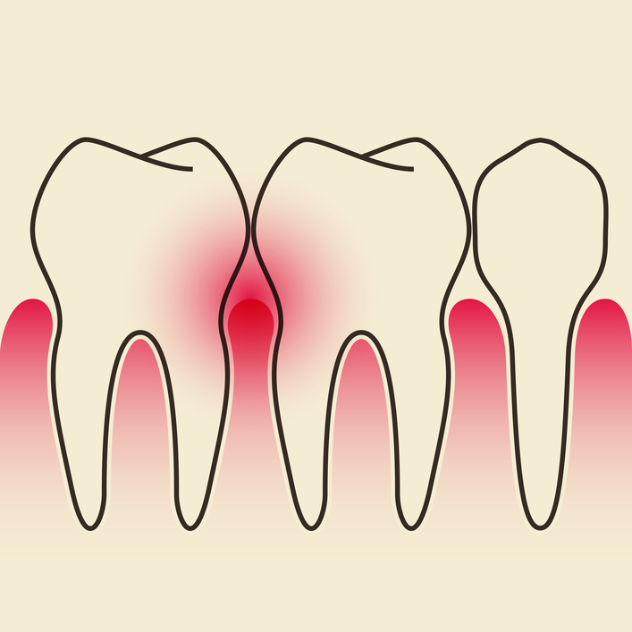 Macomb gum disease