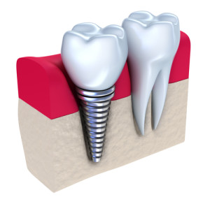 Macomb dental implants