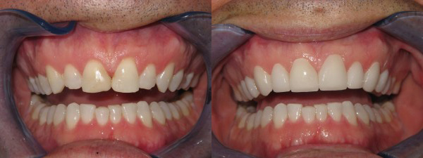 Macomb porcelain veneers