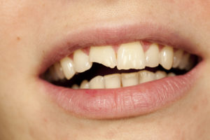 patient's mouth with a chipped tooth in need of Macomb dental treatment