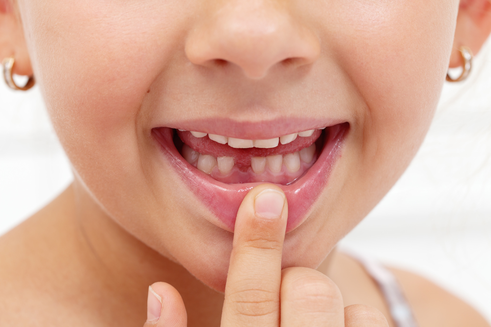 girl showing missing tooth