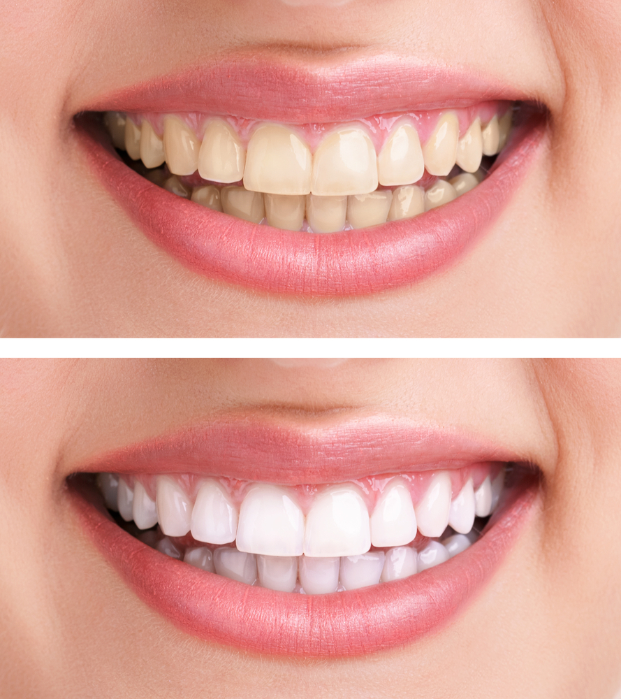 One-Day Cosmetic Dentistry Treatments