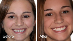 Hoffman Dental Care - Lumineers - Porcelain Veneers in Macomb, MI