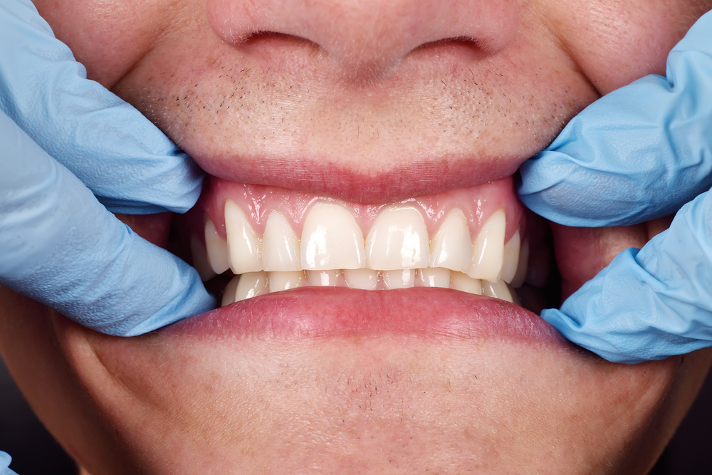 What Should Healthy Gums Look Like Hoffman Dental Care