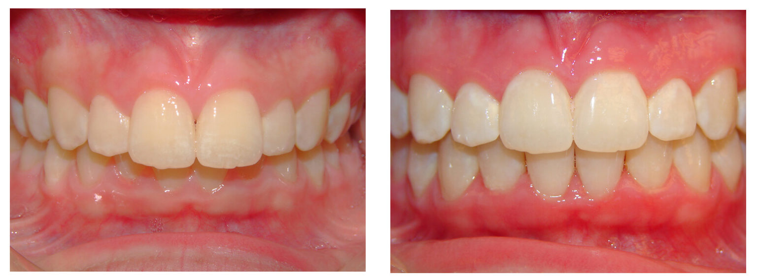 Hoffman Dental Care Invisalign Clear Braces in MI