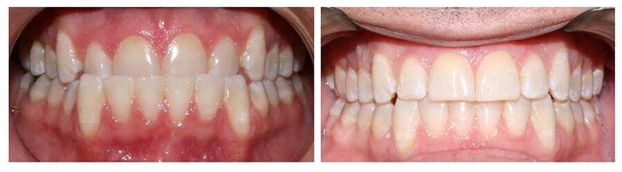 before and after invisalign