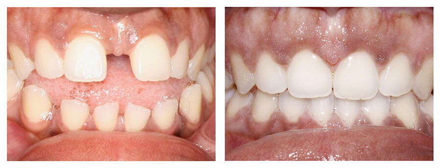 before and after invisalign