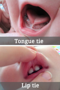 tongue tie and lip tie diagram