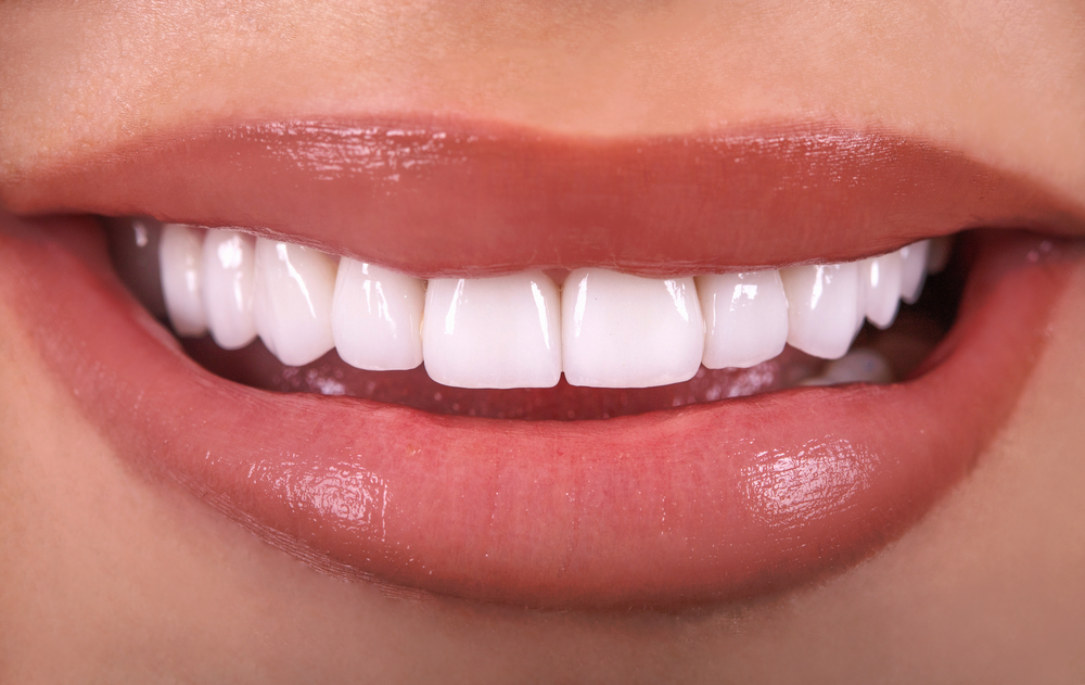 Smile transformation with no-prep veneers