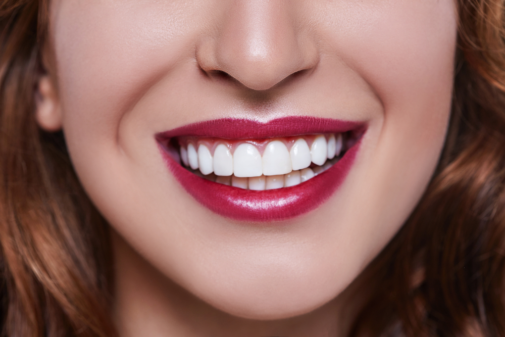 Lumineers vs veneers benefits