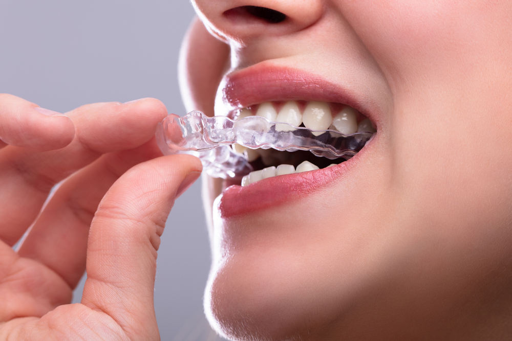 Pain and discomfort during Invisalign treatment