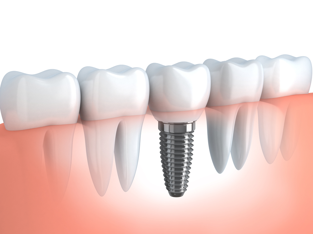 dental implant in jaw graphic