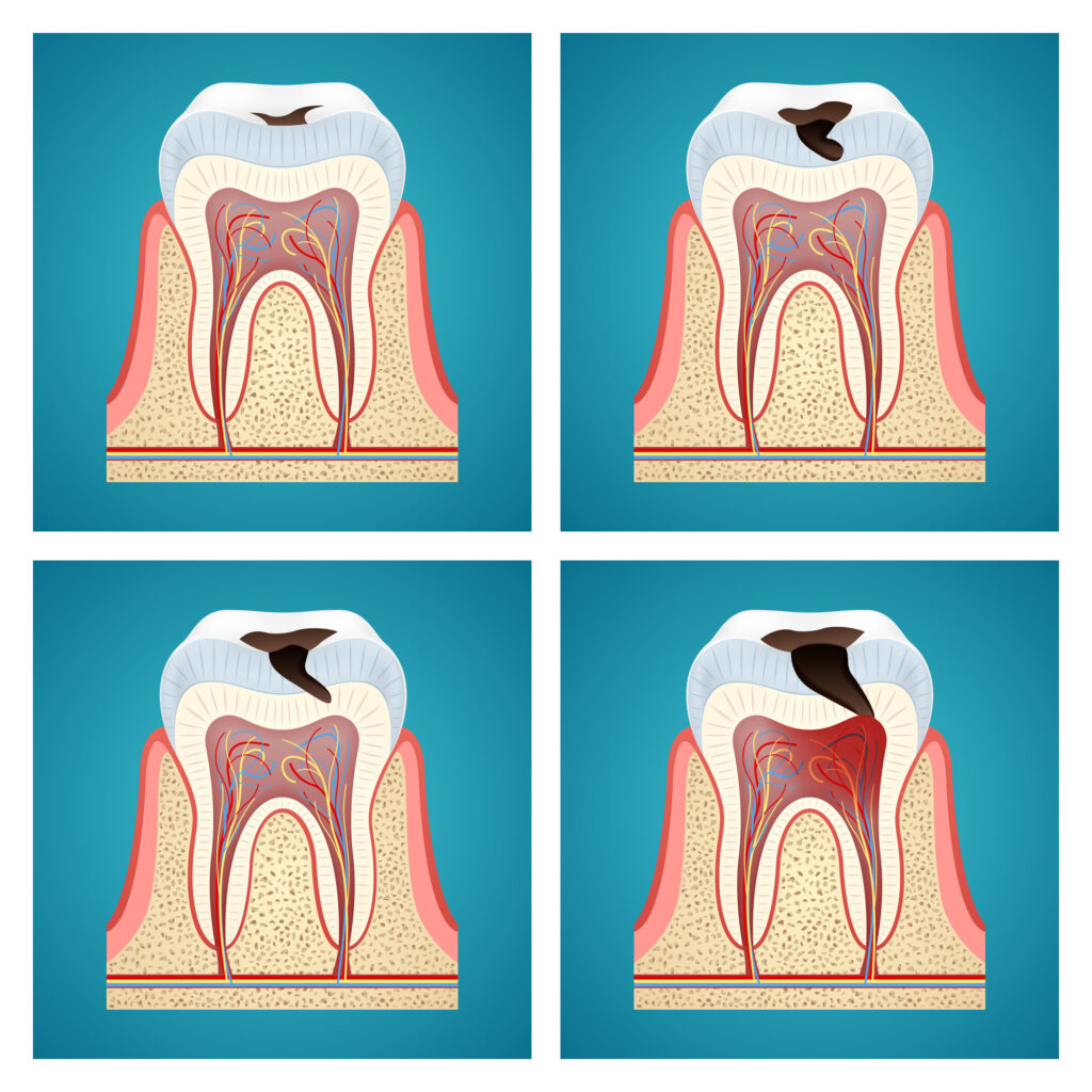 Diagram showing the stages of tooth decay. 